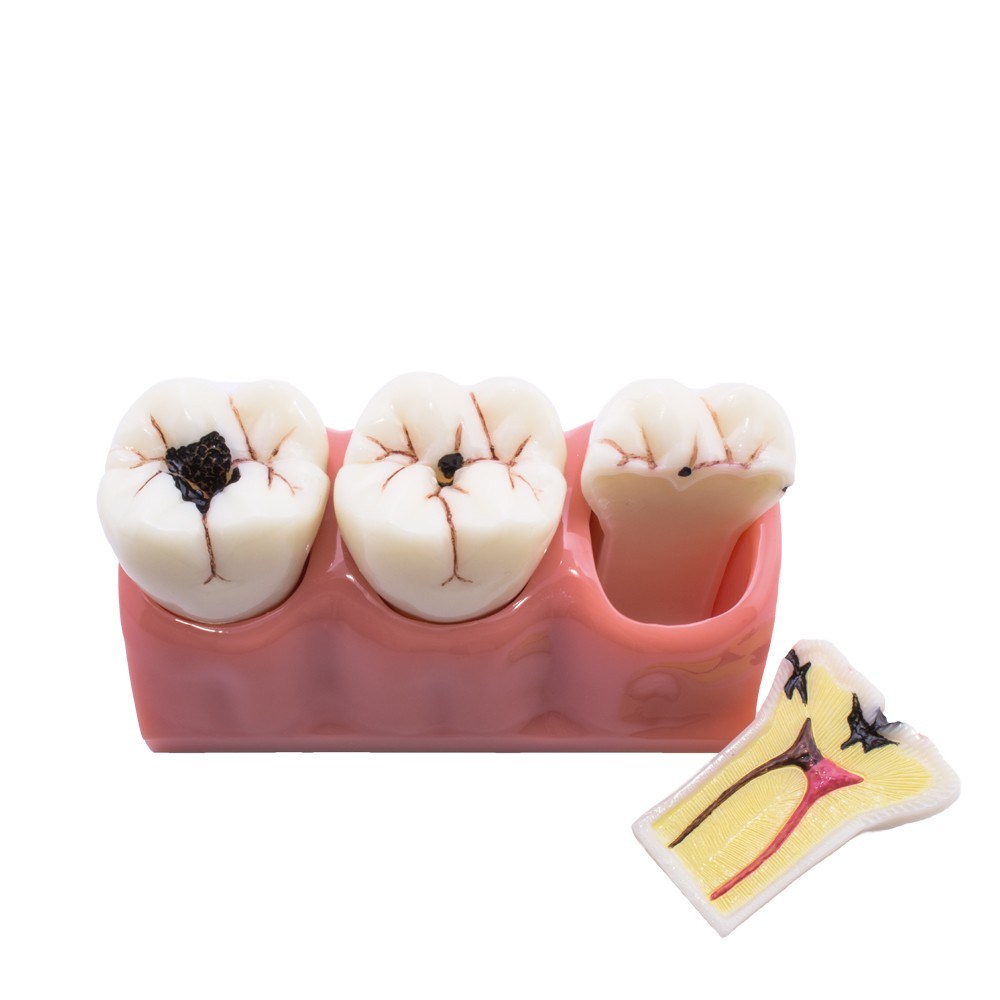 desmontable caries Bader – 0905101