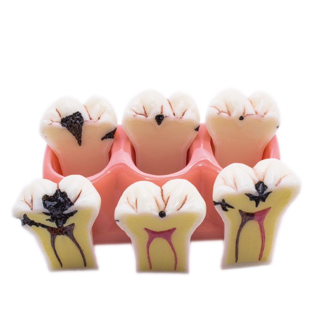 Modelo Desmontable Caries Bader – imagen 2