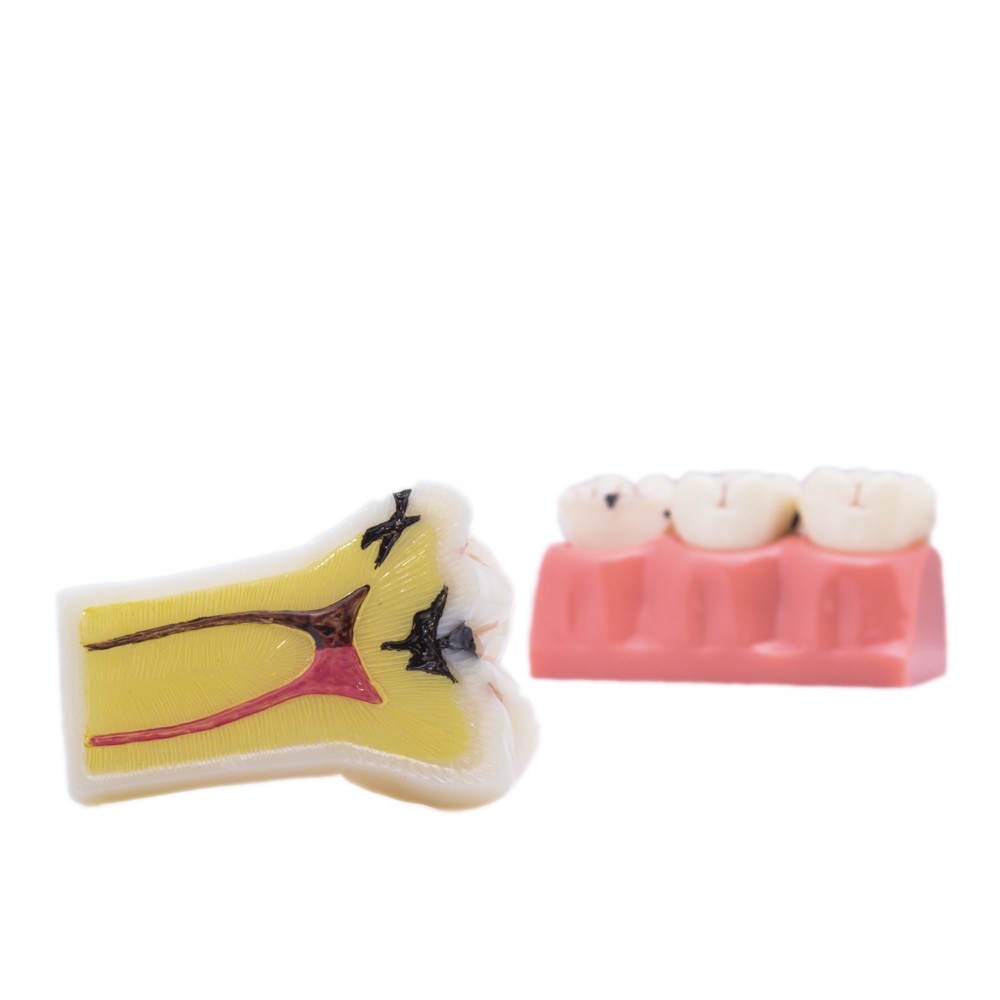 Modelo Desmontable Caries Bader – imagen 3