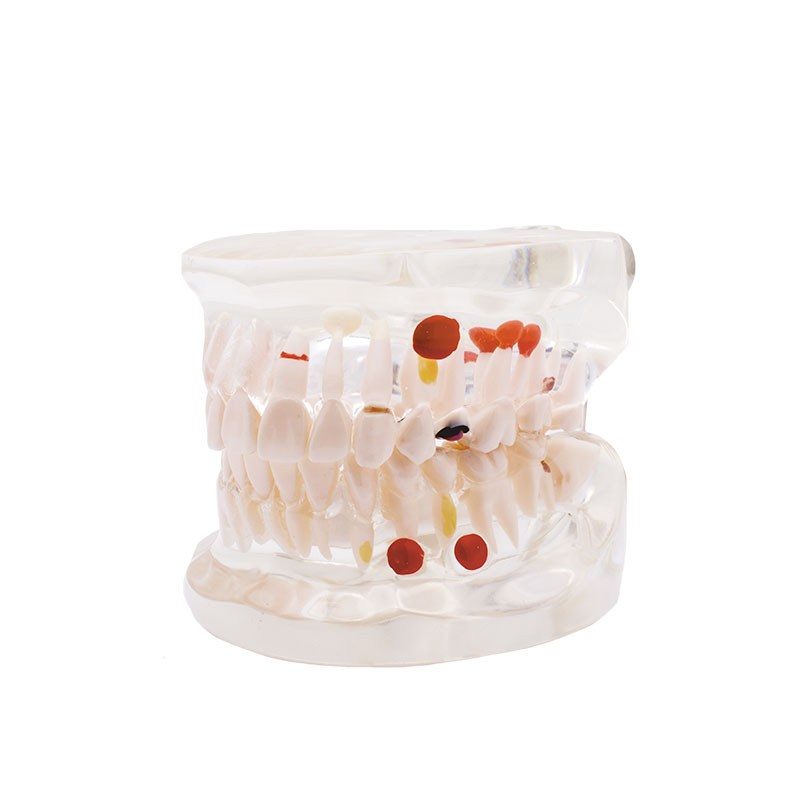 Modelo transparente de caries Bader – imagen 2