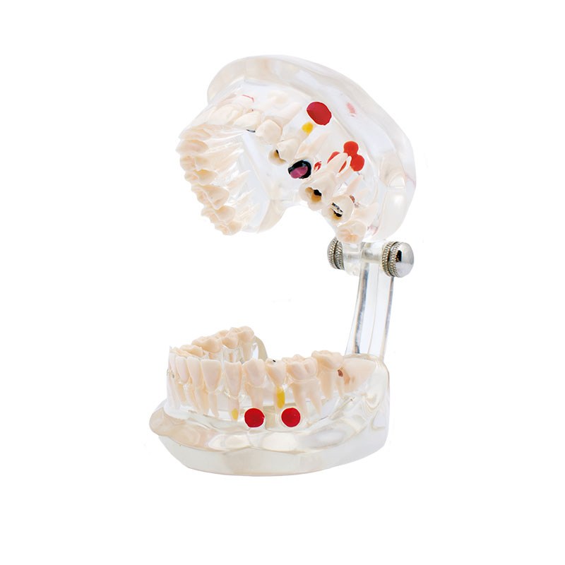 Modelo transparente de caries Bader – imagen 3