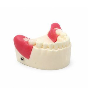 extracción dientes retenido semiretenido Bader – 0905156